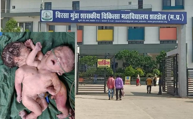 शहडोल में जन्मे जुड़वा बच्चे: चार पैर, दो सिर वाली दुर्लभ घटना ने किया सभी को हैरान